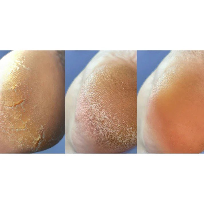 Nailsoftheday Podology+ "Cream for cracks on feet and hands"  kremas nuo įtrūkimų gydo rankų ir kojų odos įtrūkimus, 30 ml