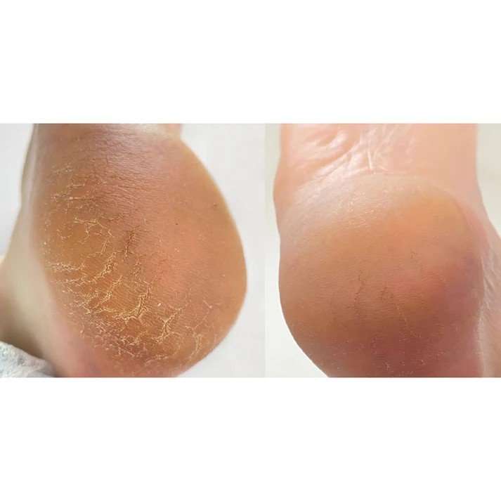 Nailsoftheday Podology+ "Cream for cracks on feet and hands"  kremas nuo įtrūkimų gydo rankų ir kojų odos įtrūkimus, 30 ml